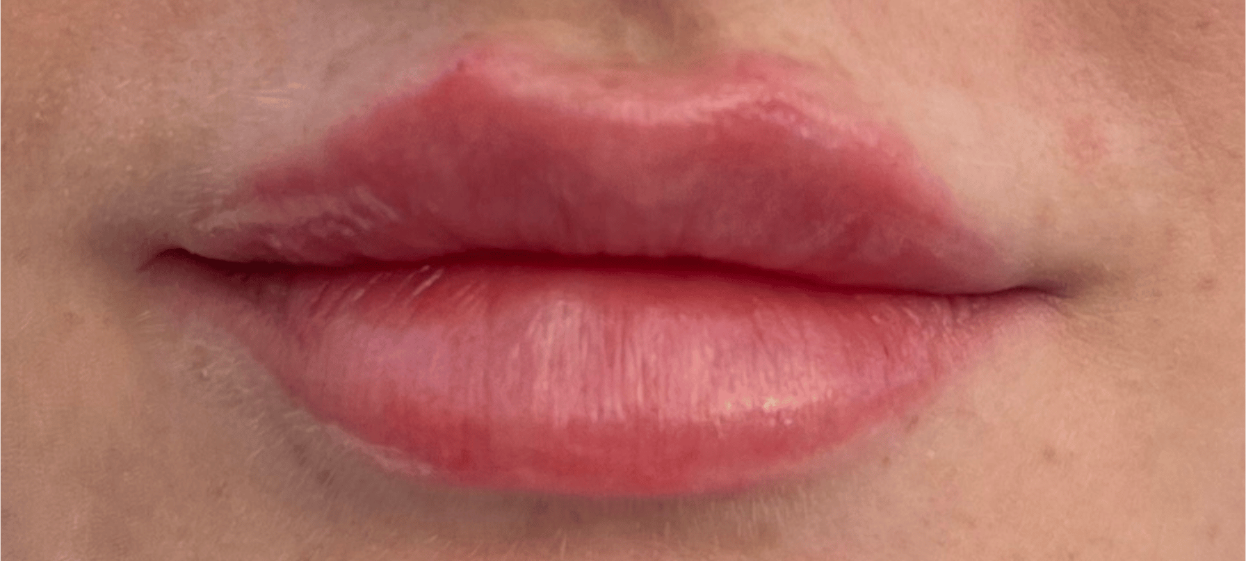 Vorher-Nachher-Bilder: Lippenaufspritzen mit Hyaluron in MÃ¼nchen erstaunliche Ergebnisse