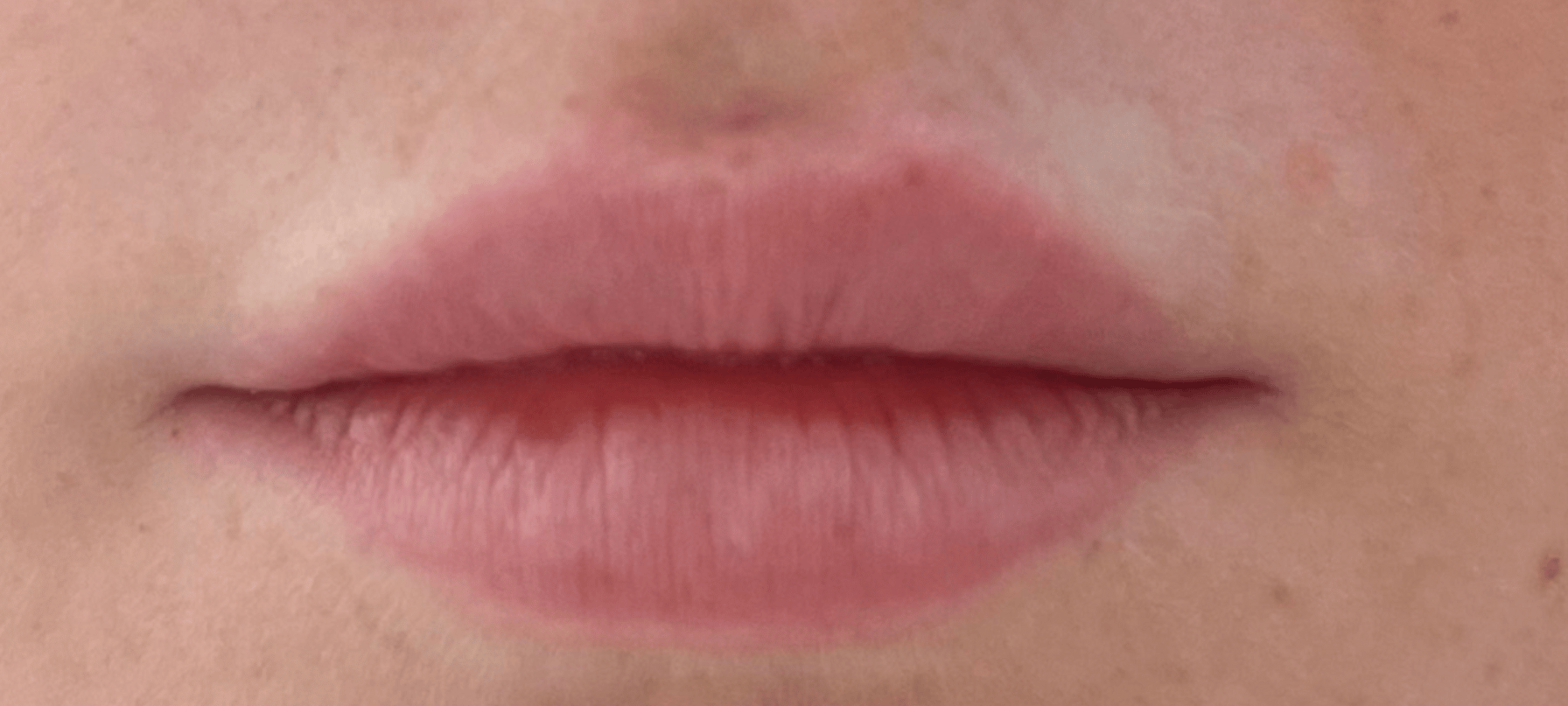 Vorher-Nachher-Bilder: Lippenaufspritzen mit Hyaluron in MÃ¼nchen erstaunliche Ergebnisse