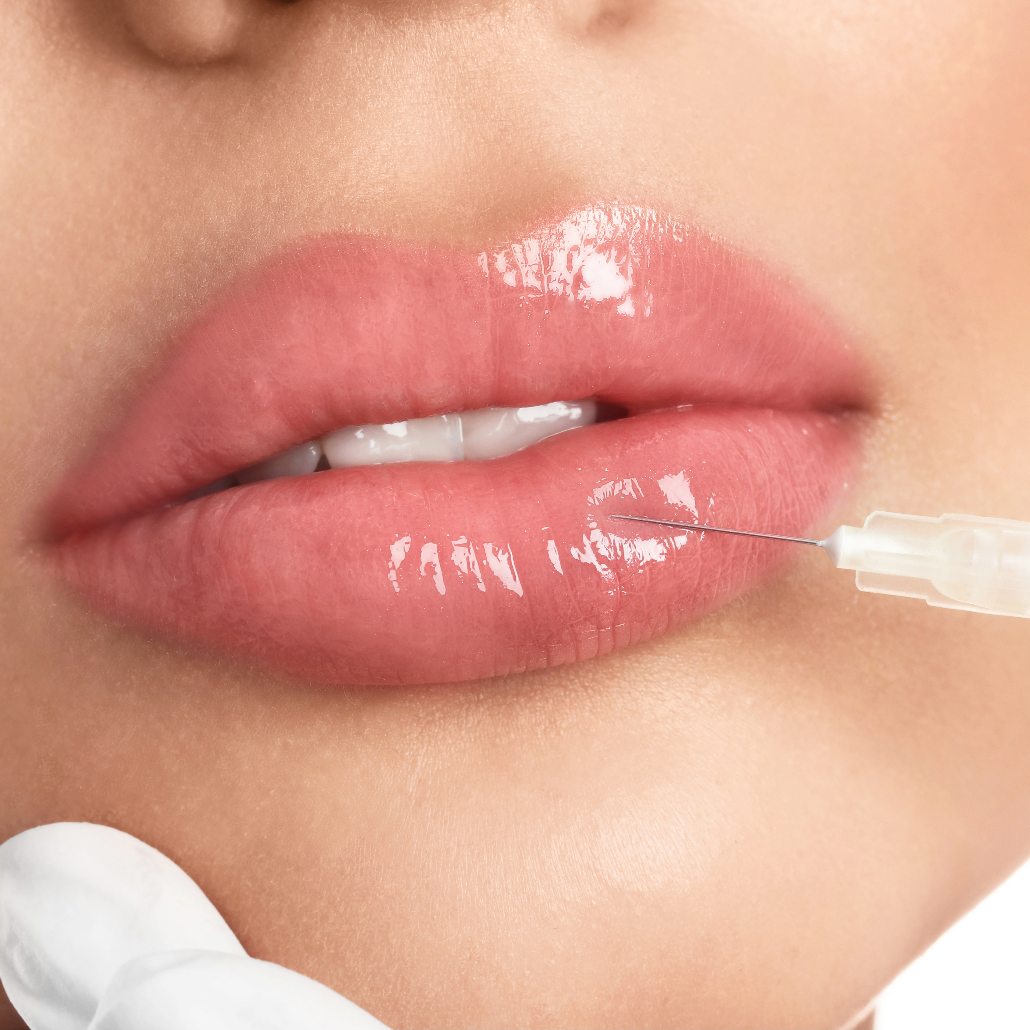 Lippenaufspritzen/Lippenunterspritzen mit Hyaluron in Mnchen