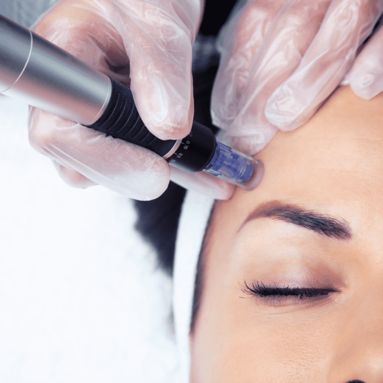 Microneedling mit PRP: Feine Nadeln stimulieren die Hautregeneration.